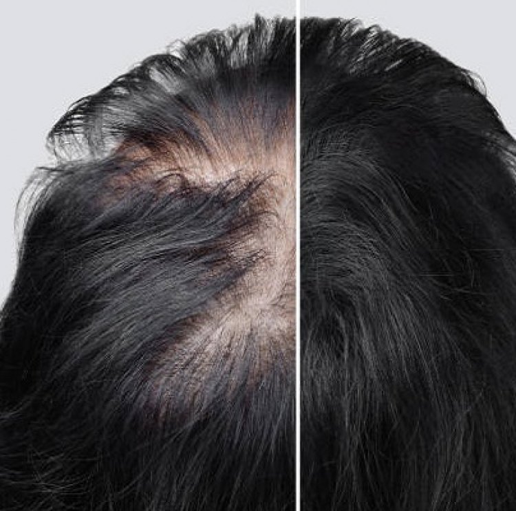 Hair Implant in Dubai & UAE At Royal Clinic ?